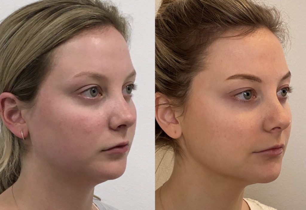 HydraFacial MD Before & After Photos - Jane Olson, MD